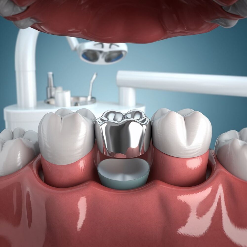 dentystyczna korona srebrna