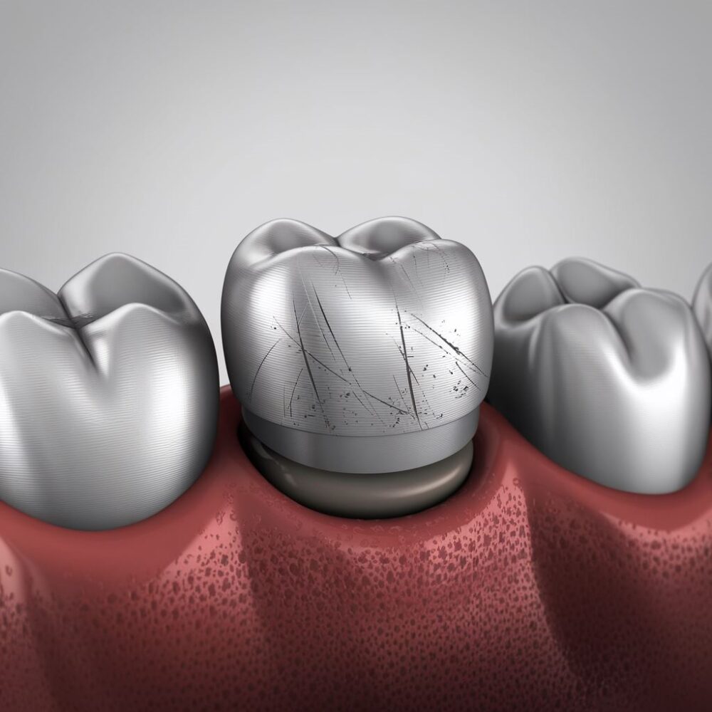 srebrna korona na zębie